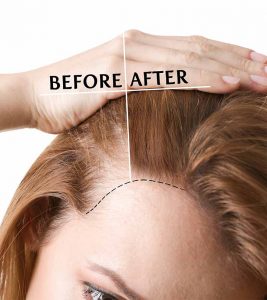 Hair Transplant in Delhi, Cheap and Best Deals