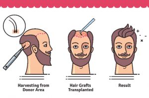 Hair Transplant in Delhi, Cheap and Best Deals