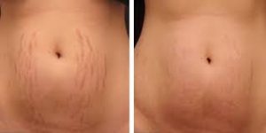 Stretch Marks Removal in Delhi by Laser Technique, Best offers