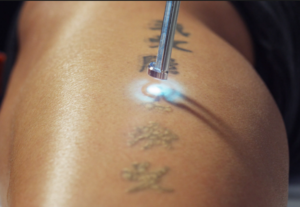 Proper Information About Tattoo Removal, Procedures and Common Faq