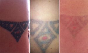 Proper Information About Tattoo Removal, Procedures and Common Faq