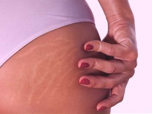 Want to Remove Stretch Marks Permanently These Treatment Will Help You Out