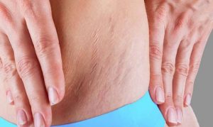 How To Remove White and Red Stretch Marks
