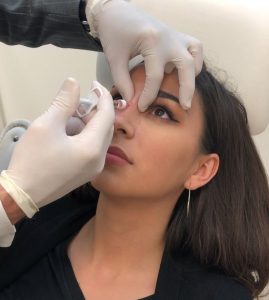 Non-surgical Nose Job best Treatment, Recovery, and Results