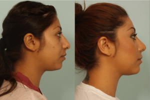 Face Contouring Treatment, Procedure, Candidates, And Cost