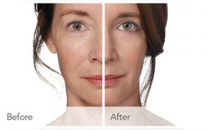 Botox, Dermal Fillers Procedures and Benefits