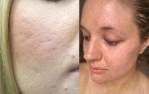 These are the best ways to remove your stubborn Acne Scars