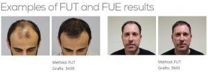 FUE Vs FUT Hair Transplant Full Detail