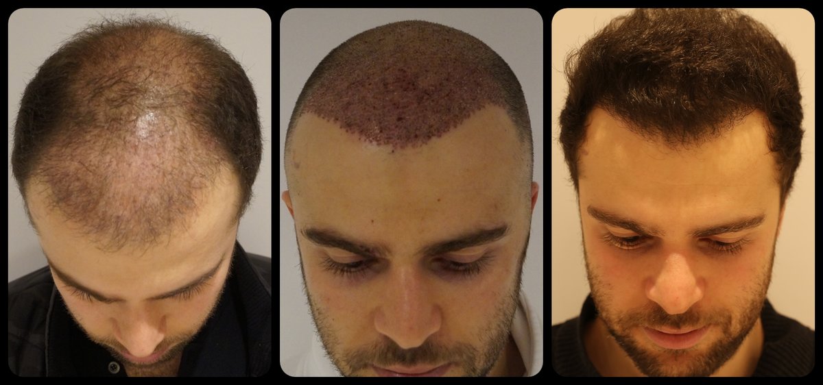 Hair Transplant in Delhi, Cheap and Best Deals