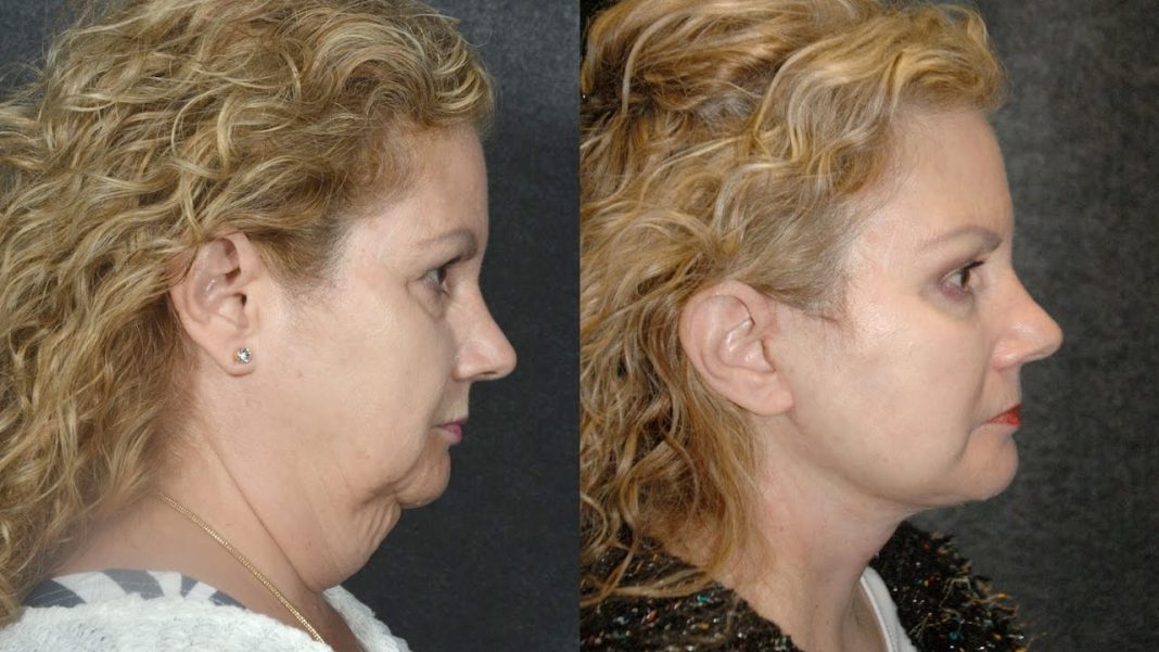 Neck Lift Non-Surgical Treatment And FAQ